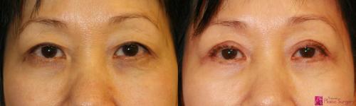 asian-eyelid-surgery-half-moon-bay