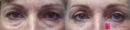 blepharoplasty-eyelid-surgery-half-moon-bay
