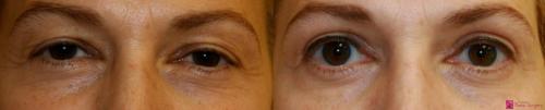 blepharoplasty-eyelid-surgery-los-gatos-1