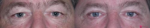 blepharoplasty-eyelid-surgery-palo-alto-1