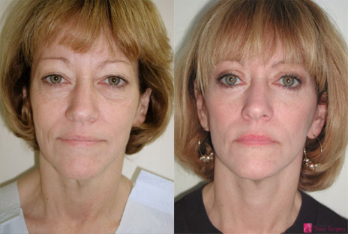 facelift-before-after-4