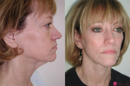 facelift-before-after-5