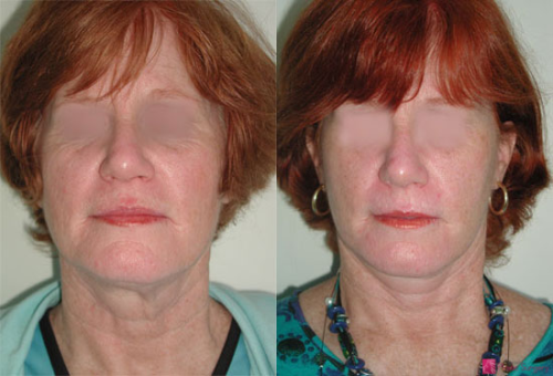 facelift-before-after-photos-1