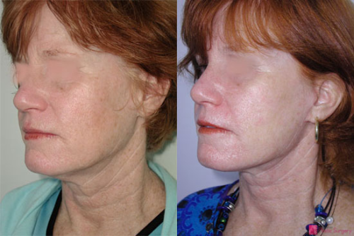facelift-before-after-photos-2