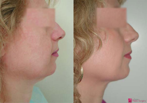 facelift-before-after-photos-5
