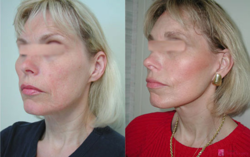 facelift-before-after-photos-6