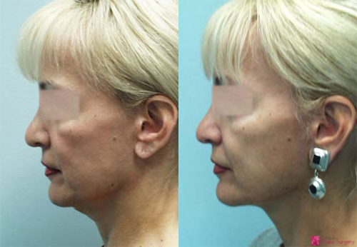 facelift-before-after-photos-8