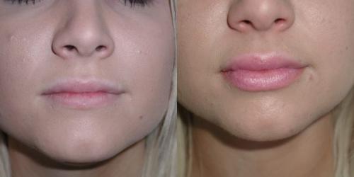 lip-lift-before-after-2