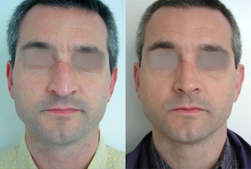 rhinoplasty-before-after-photos-2